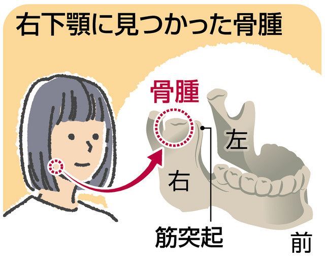 あーんができる幸せ 口腔外科手術体験記 上 口が2センチしか開かない 見たことない 数センチの塊 東京新聞 Tokyo Web