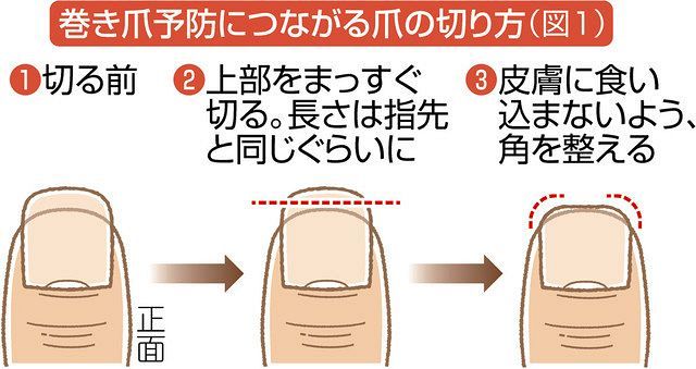 ケアして予防 巻き爪 陥入爪 伸ばしすぎない 適度に歩く 東京新聞 Tokyo Web