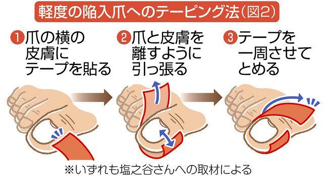 ケアして予防「巻き爪」「陥入爪」 伸ばしすぎない／適度に歩く：東京新聞 TOKYO Web