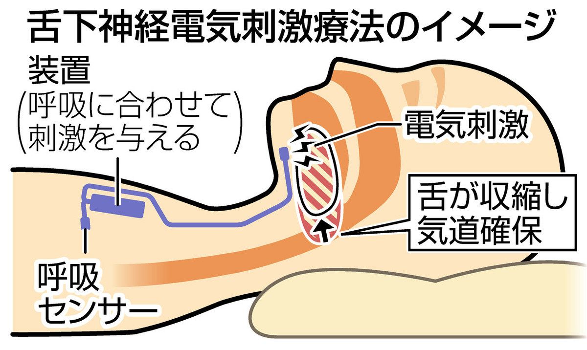 睡眠時無呼吸に電気療法 装着の手間なく気道確保 体内に装置 舌 睡眠時無呼吸に電気療法 装着の手間なく気道確保 体内に装置 舌