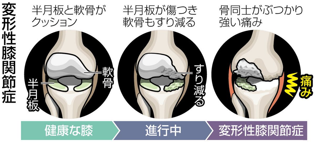 変形性膝関節症、治療法選べる時代 歩く機能保ち健康寿命延伸：東京