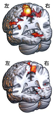 （上）切断した右脚を動かした時の鈴木徹の脳の活動領域（赤）。左脳だけでなく右脳にも広がっている（下）左脚を動かした時の鈴木の脳の活動領域（赤）。右脳のみが活動している＝（Ｃ）２０１９東大中沢研究室