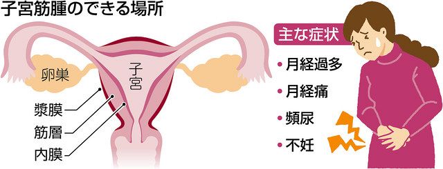 子宮筋腫ある人増加 腹腔鏡手術で負担軽減 入院6日間 開腹 の半分 東京新聞 Tokyo Web