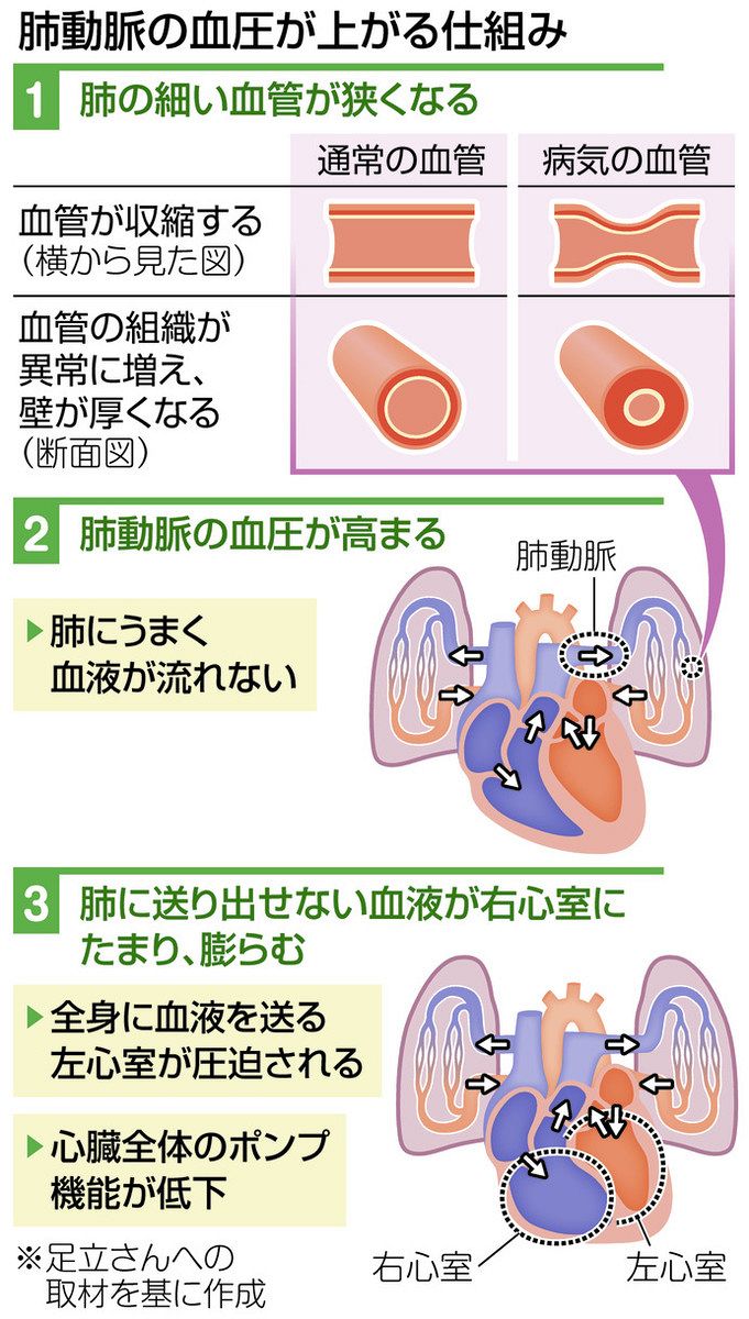 肺 高血圧 症