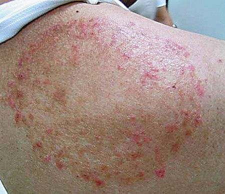 水虫菌によって発疹が広がった背中（常深教授提供）