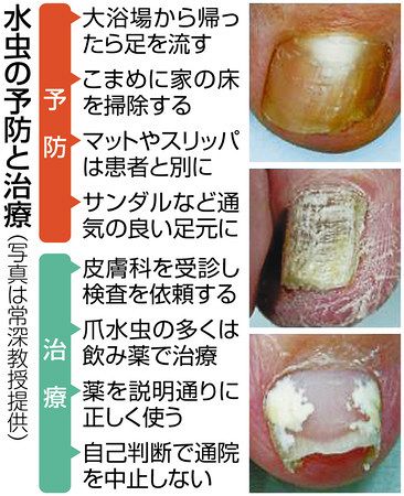 爪水虫 治療遅れで全身に増殖も 感染防止足裏を清潔に 東京新聞 Tokyo Web