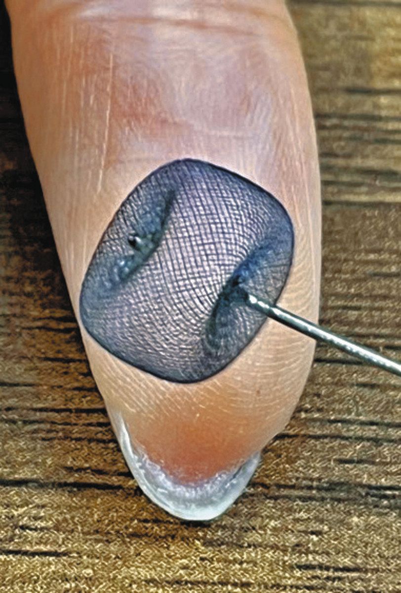 脳動脈瘤」新治療で実績 金属器具「ウェブ」を入れ血流遮断 藤田医科大