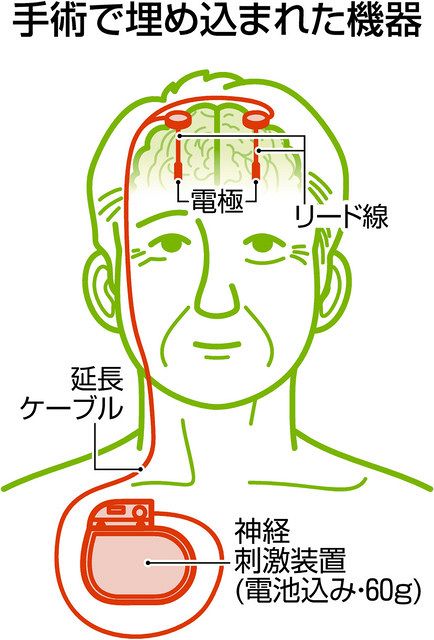 わけあり記者がいく＞全身麻酔で手術も仕上げ 「脳のサポート機器