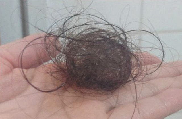 コロナの後遺症で抜けたとみられる女性の洗髪後の毛玉＝本人提供