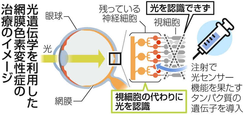国内に3万人「網膜色素変性症」新治療薬の臨床試験がスタート 失明状態