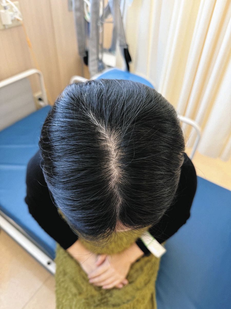 乳がん 抗がん剤の脱毛抑える「頭皮冷却療法」 外見変わる苦痛