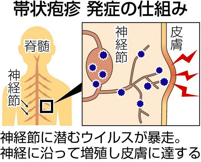 加齢で増加 帯状疱疹 ワクチンで予防は可能 東京新聞 Tokyo Web