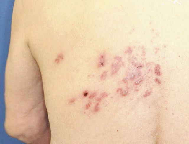 帯状疱疹の合併症を防ぐにはどうすればよいですか?