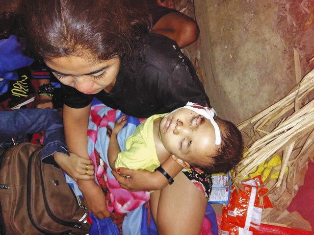 １日、ミャンマー・カイン州で、国軍の空爆で顔にけがをしたカレン族の子ども＝Ｆｒｅｅ　Ｂｕｒｍａ　Ｒａｎｇｅｒｓ提供