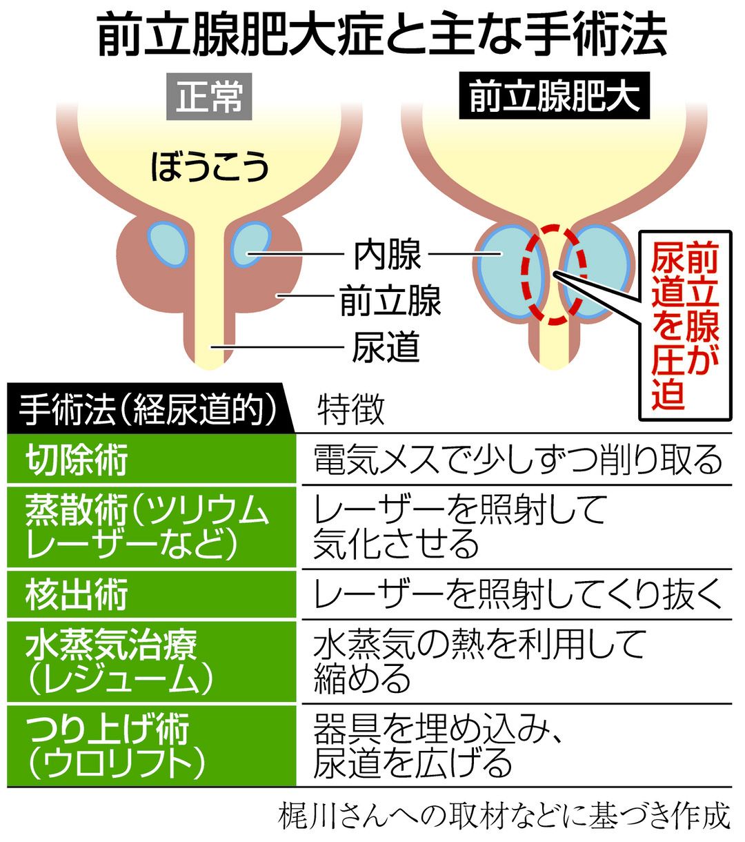 前立腺肥大は日帰り手術で完治する おしっこの悩みからガンの不安まで ...