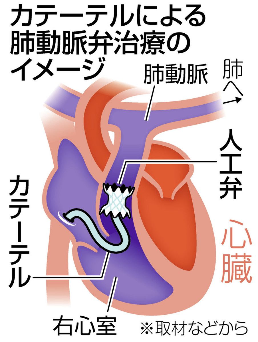 肺動脈弁」治療 カテーテル導入 人工弁取り付け 体の負担軽く 開胸手術