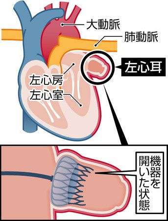 左心房の心耳