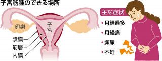 子宮筋腫ある人増加　腹腔鏡手術で負担軽減　入院6日間「開腹」の半分